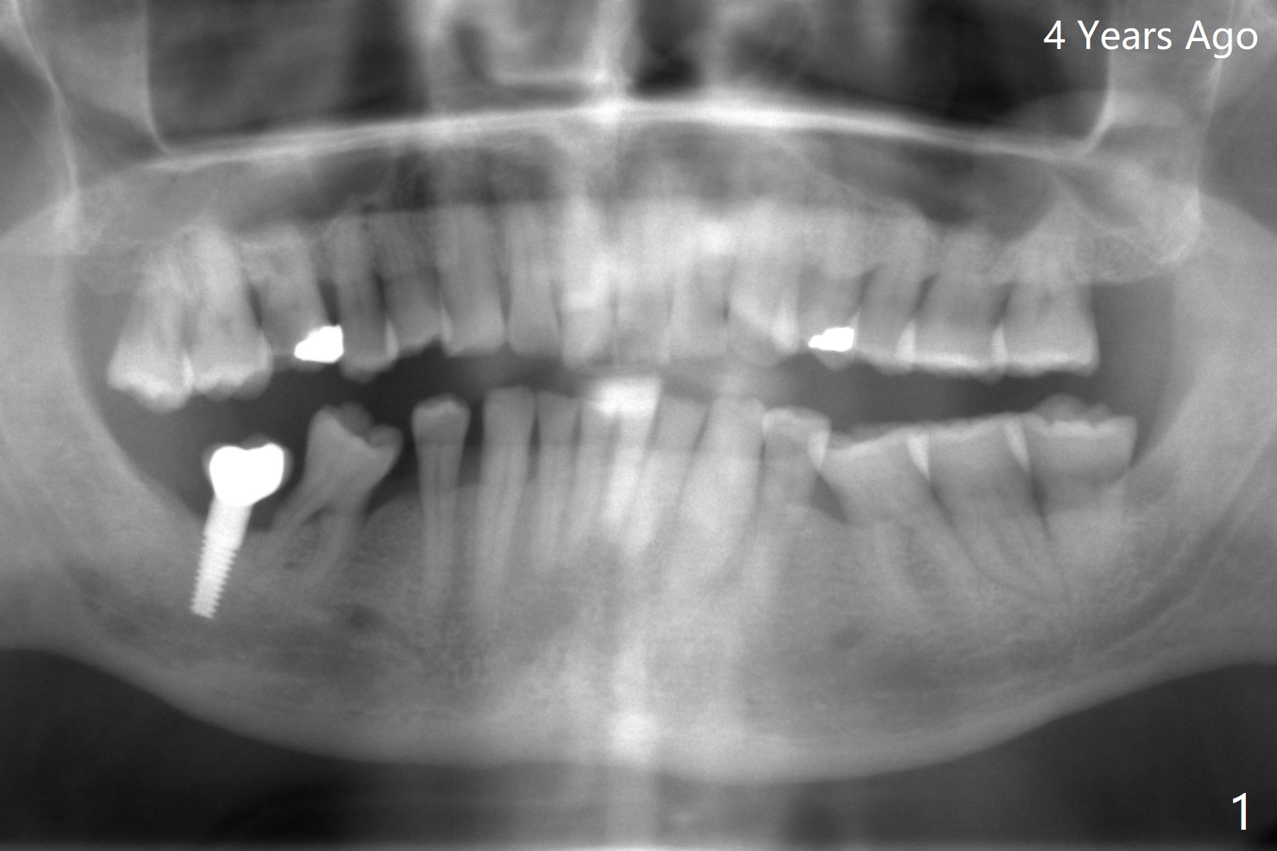 Composite Marker for Guided Immediate and Delayed Implants When the